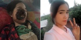 После удаления зуба девушка почти лишилась лица