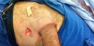 Спасли руку от ампутации, пришив ее к животу