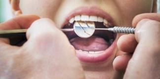 Стоматологи предлагают лечить кариес с помощью аспирина