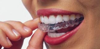 Невидимые брекеты: особенности системы Invisalign